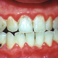 Gengivite acuta causata da cattiva igiene orale