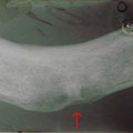 Stessa cisti della panoramica precedente, la cisti ingloba il fascio vascolo-nervoso del forame mentoniero