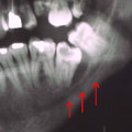 Secondo molare inferiore incluso con riassorbimento osseo periradicolare prossimo al canale mandibolare