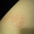 Läsionen beim Menschen durch Microsporum spp.