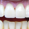 Welche Zähne wurden mit Veneers behandelt?