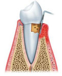 歯周病　Ｐ３