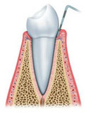 歯周病　Ｐ１