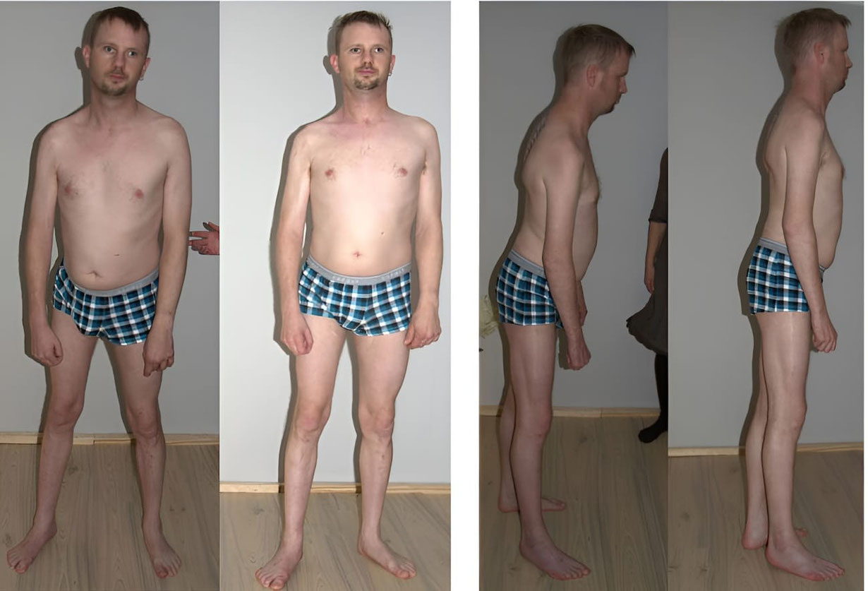 Patient vor und nach der ersten Sitzung Senmotic Faszien Therapie in Frontalansicht und im Profil