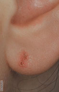eczema allergique tige boucle oreille