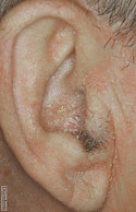 photo de dermite seborrheique de l oreille