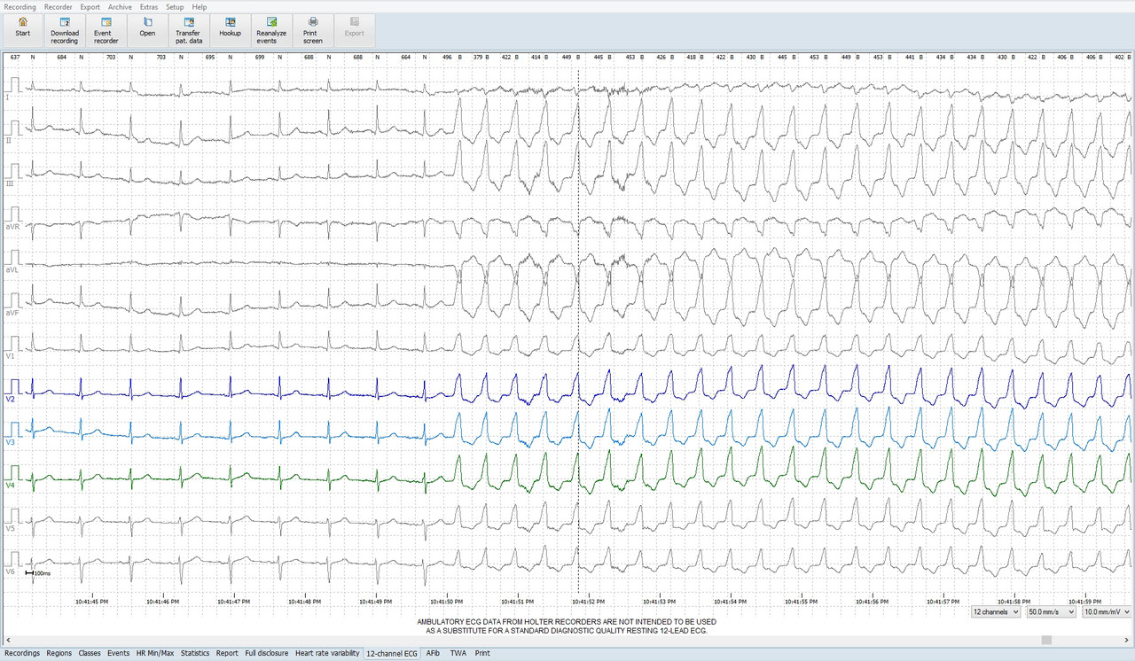 LangzeitEKG FokusEKG