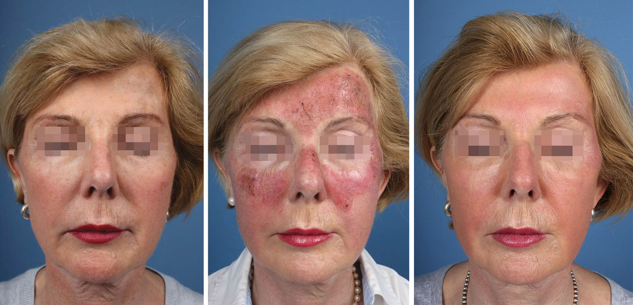 Laser-PDT mit Tageslicht - DERMAforum - Zeitung für Dermatologie und Allergologie