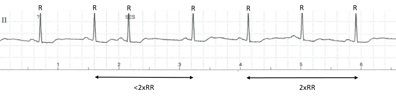 Supraventrikuläre Extrasystolen - Fokus-EKG