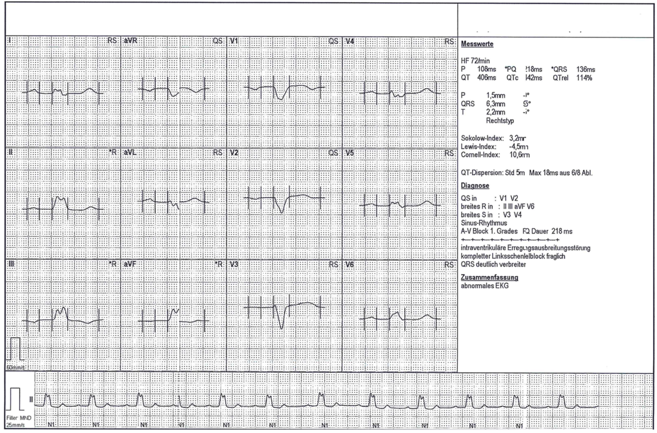 Linksschenkelblock im EKG FokusEKG