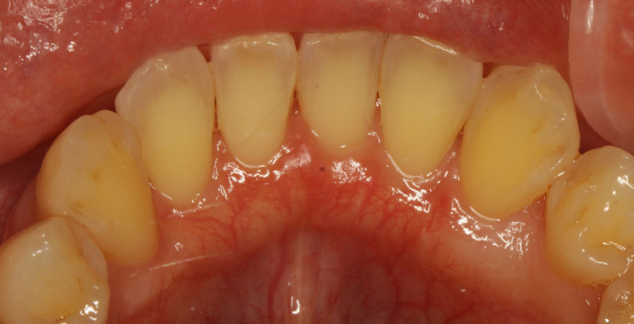 前歯 の 裏 の 歯茎