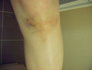 Und so sieht inzwischen mein blauer Fleck aus (17.09.08).