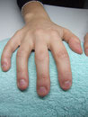 Nagelbeisserin vorher