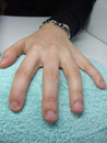 Nagelbeisserin vorher