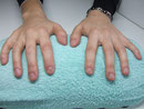 Nagelbeisserin vorher