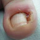 Granuloma