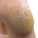 Callo Dorsal