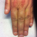 linke Hand vor Behandlung