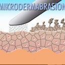 Diamant-Mikrodermabrasion
