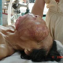 顔面にできた3キロもの巨大な腫瘤を摘出した女性