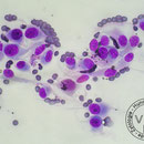 polymorphe Fibroblasten - Fibrosarkom