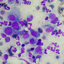 aktivierte Makrophagen - granulomatöse Entzündung