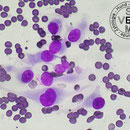 polymorphe Fibroblasten - Fibrosarkom