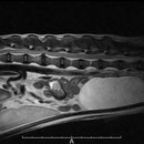 椎間板ヘルニア（MRI)