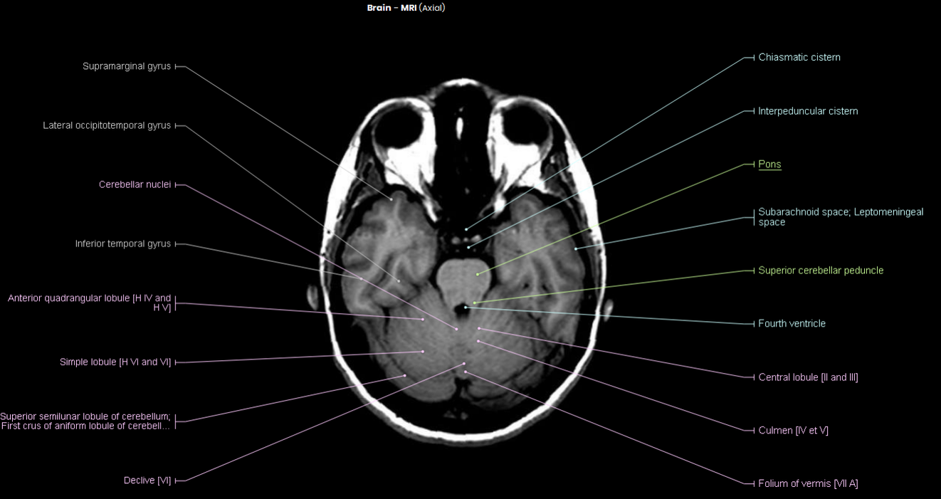 Brain MRI
