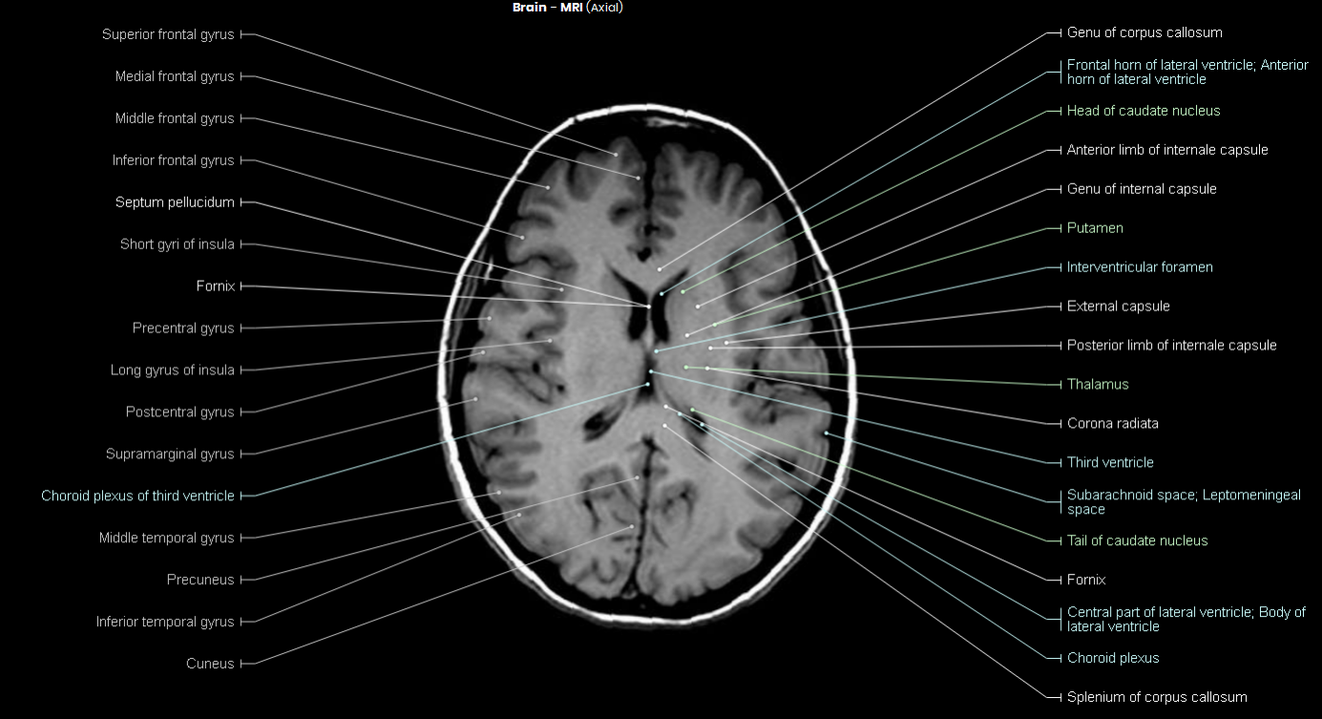 Brain MRI