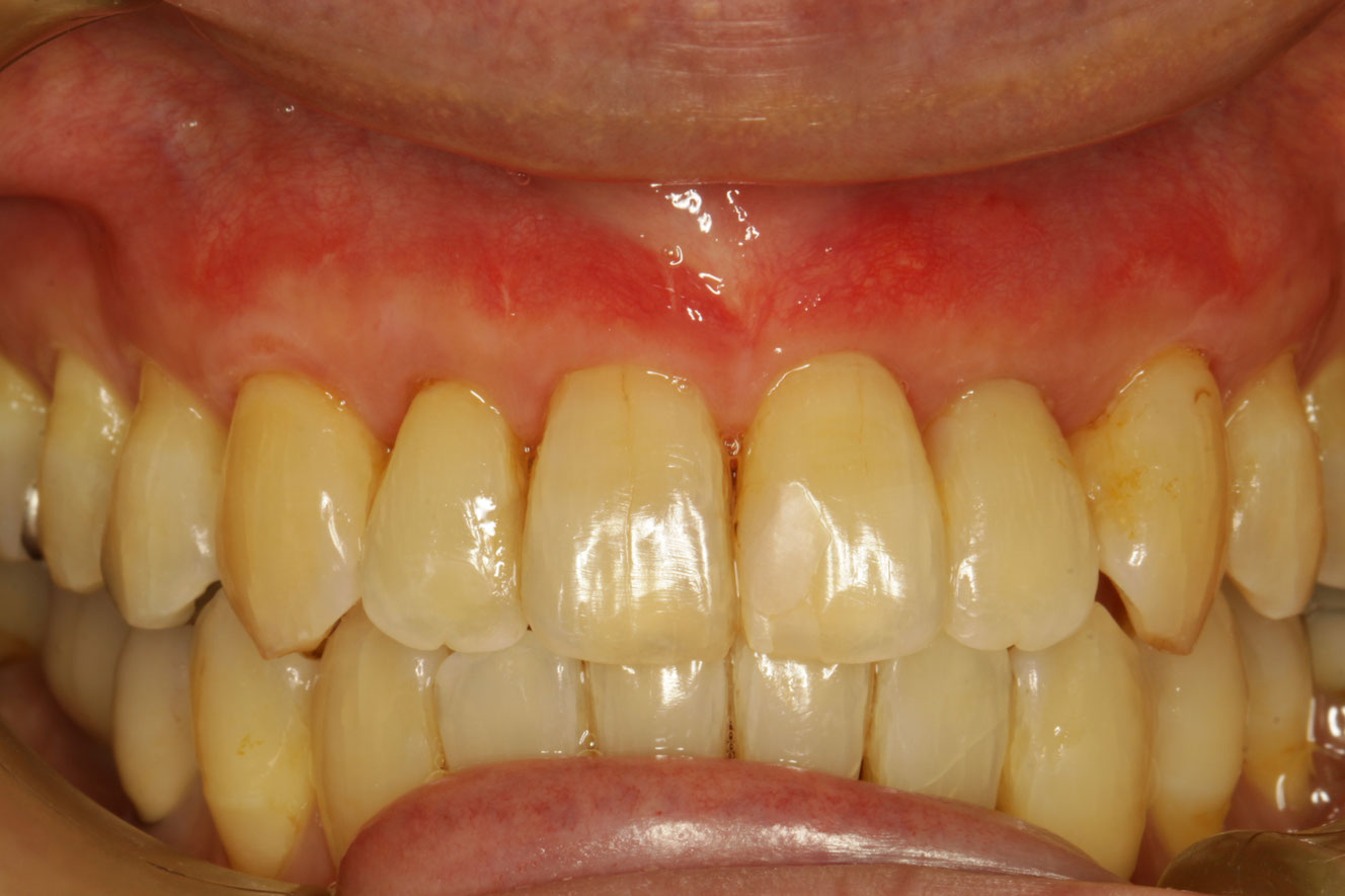 歯茎が下がってしまった時の治療方法 神田ふくしま歯科