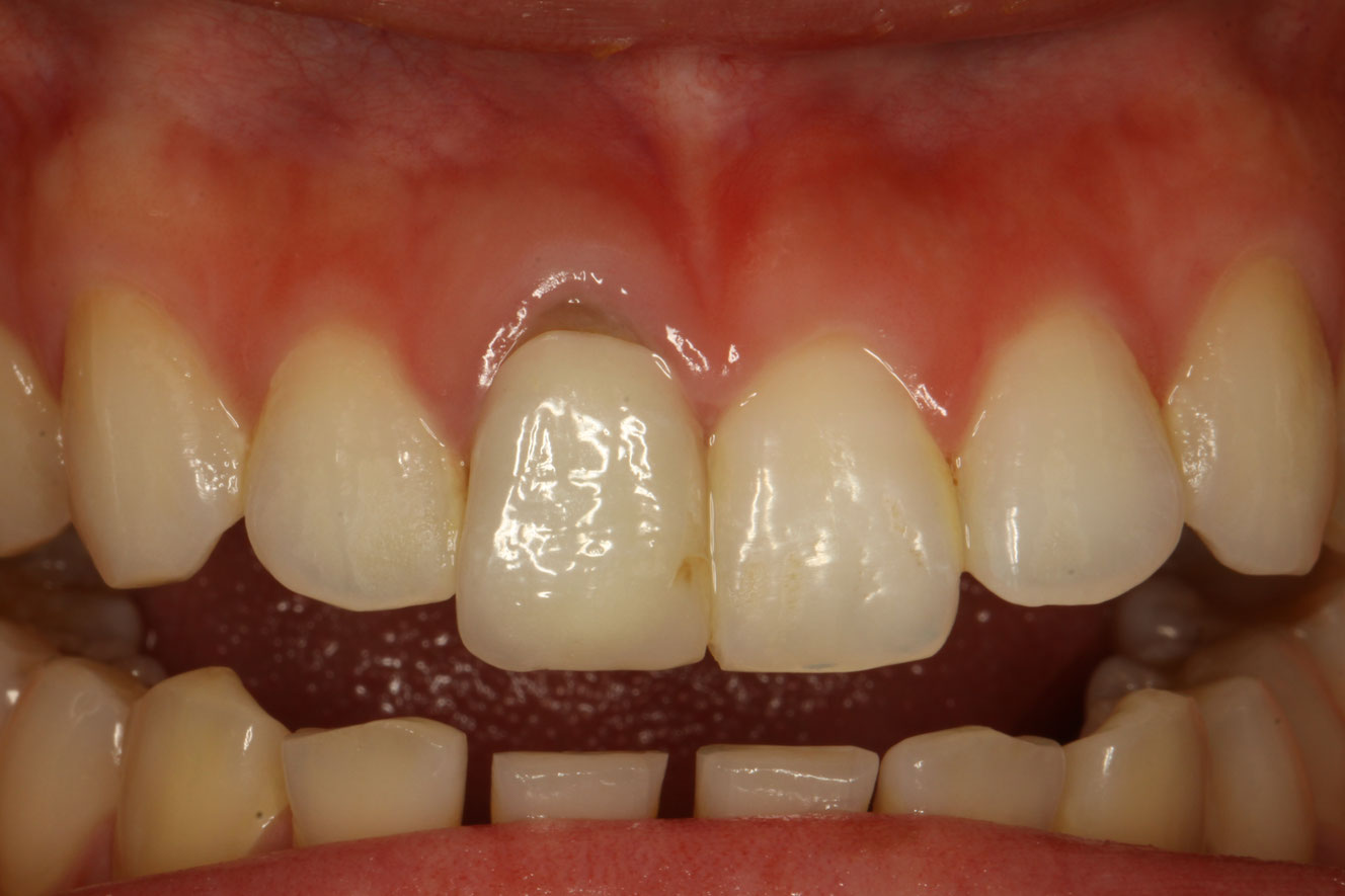 差し歯の歯茎が下がってしまった時の歯科治療 神田ふくしま歯科