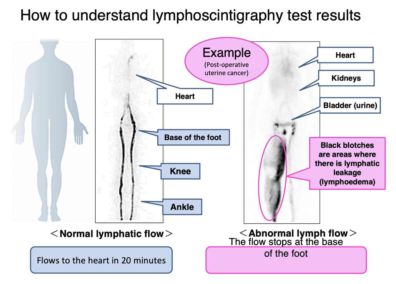 Lymphoscintigraphy of Lower Limba