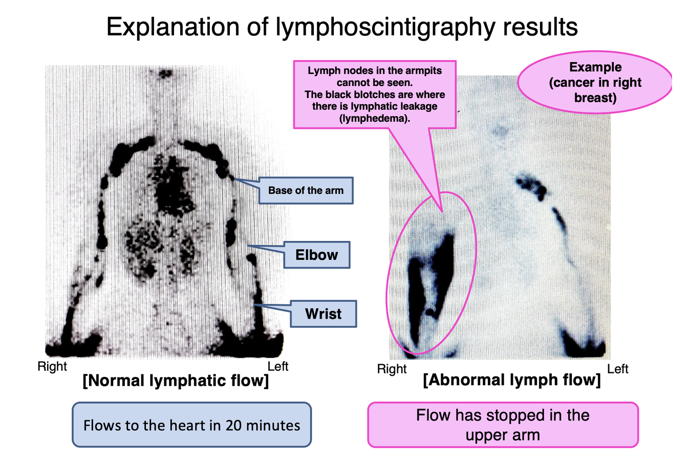 Lymphoscintigraphy of Upper Limb