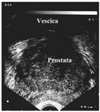 Ecografia prostatica transrettale