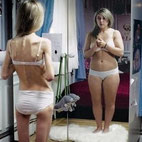 maladie anorexie