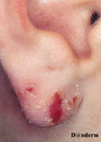 photo d'un eczéma sur boucle d oreille chez une femme noire