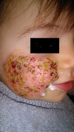 L Eczema Du Visage Adulte Conseils Pratiques Eczema Atopique L Eczema Du Visage Adulte Conseils Pratiques Eczema Atopique