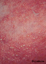 psoriasis pustuleux 