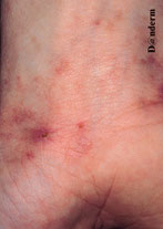 Dyshidrose (mains/pieds). Un eczéma, plusieurs causes. - Eczéma ...