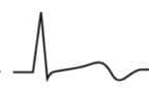 EKG T-Welle biphasisch 1