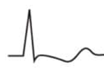 EKG T-Welle biphasisch 2