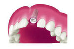 Eingeheiltes Implantat