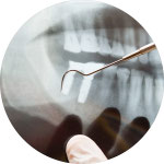 Häufige Fragen zu Implantaten und Antworten von Dr. Simon Müller, Zahnarzt in Kastellaun