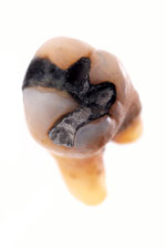 Amalgam