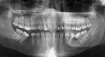 Kippung der Zähne rechts und links in die Zahnlücke