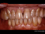 上顎左側中切歯にメタルセラミックスクラウン。下顎右側側切歯〜第一小臼歯の３本ブリッジのメタルセラミックスクラウンが入った状態