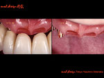メタルセラミックスブリッジの形状に歯肉は一致し、欠損部も生えているかのように見える歯肉の形状。