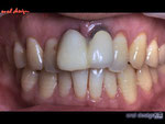 以前の歯科院でインプラント治療をおこない、そのインプラントの上に前歯2本のメタルセラミックスクラウンを被せた治療 がなされていた。２前歯のメタルセラミックスクラウンの歯肉が下がり、歯の動揺も見られ、審美障害を訴え来院。