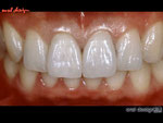 術前の歯牙よりも前突（出っ歯）にならないよう内側に入れ、正中線も修正され、控え目に製作されたメタルセラミックスクラウン。